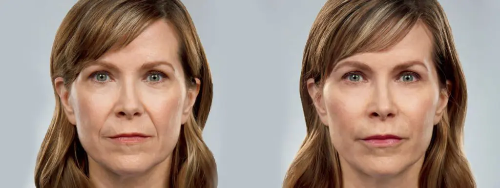 A woman before and after undergoing cosmetic surgery.