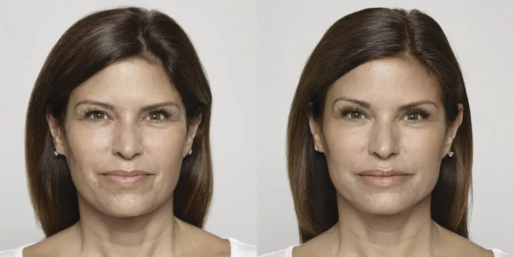 A woman before and after undergoing botox.