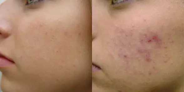 A before and after photo of a person with acne.