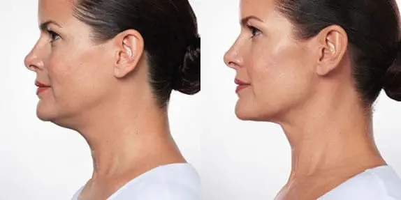 A woman with a neck lift and a side view of the same person.