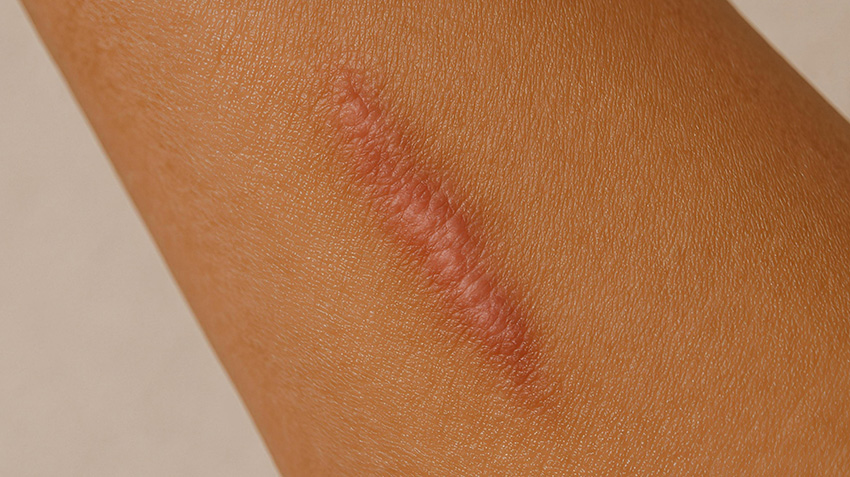 Hypertrophic Scars