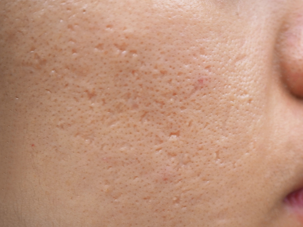 Ice Pick Scars