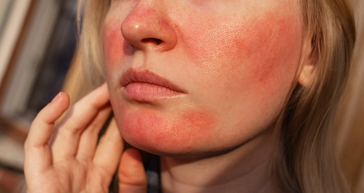 Rosacea Treatment in Asheville and Hendersonville
